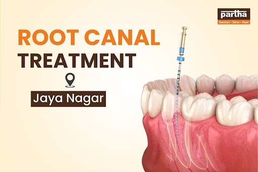 root canal treatment in jayanagar