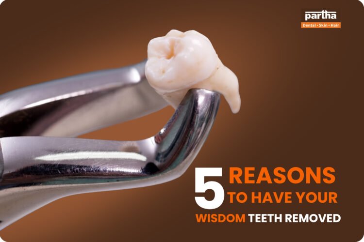reasons to have wisdom teeth removed