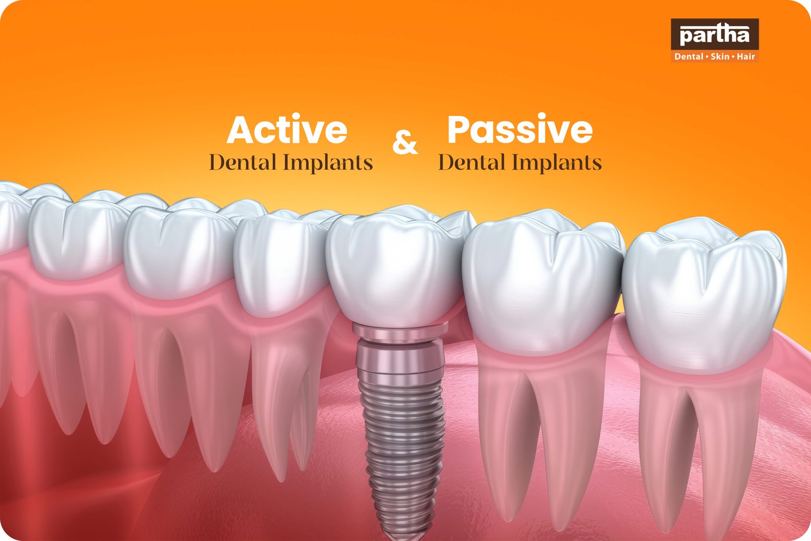 Active-vs-Passive-Dental-Implants