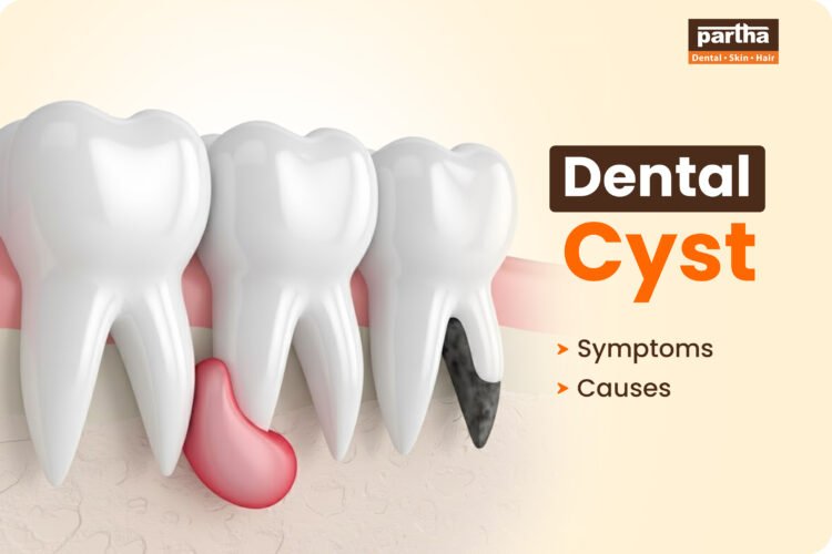 dental cyst