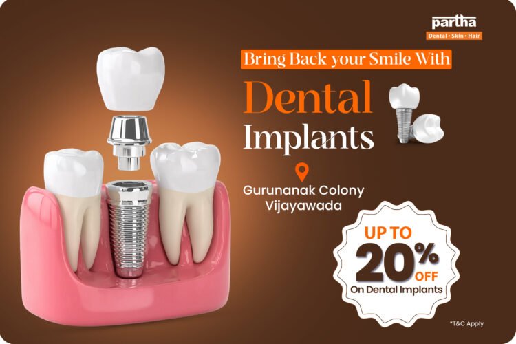 Dental Implants in Gurunanak Colony