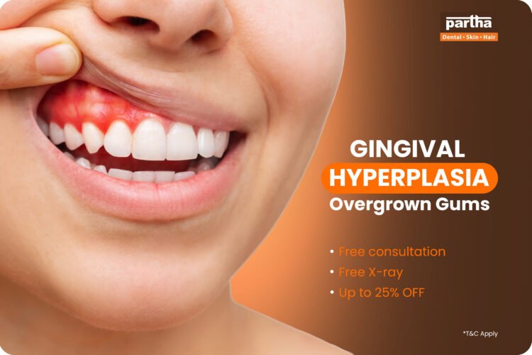 Gingival Hyperplasia overgrown gums at partha dental