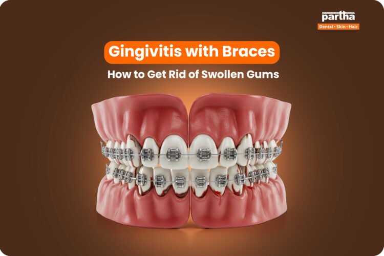 Gingivitis With Braces