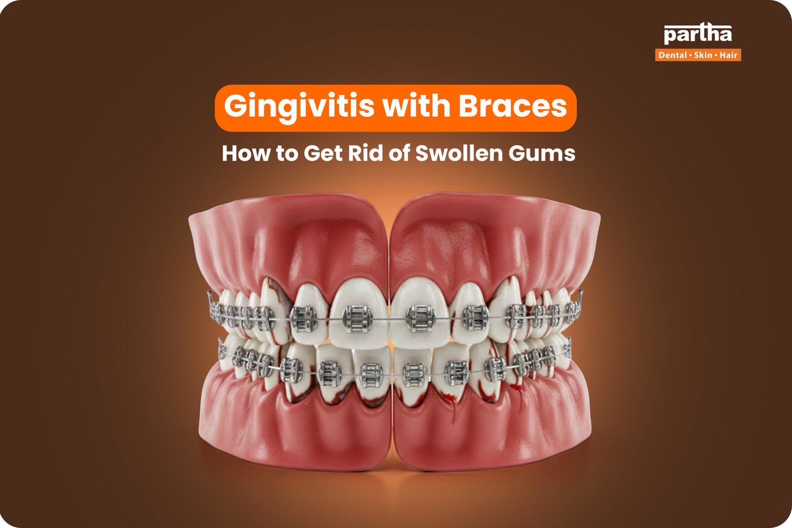 Gingivitis With Braces scaled