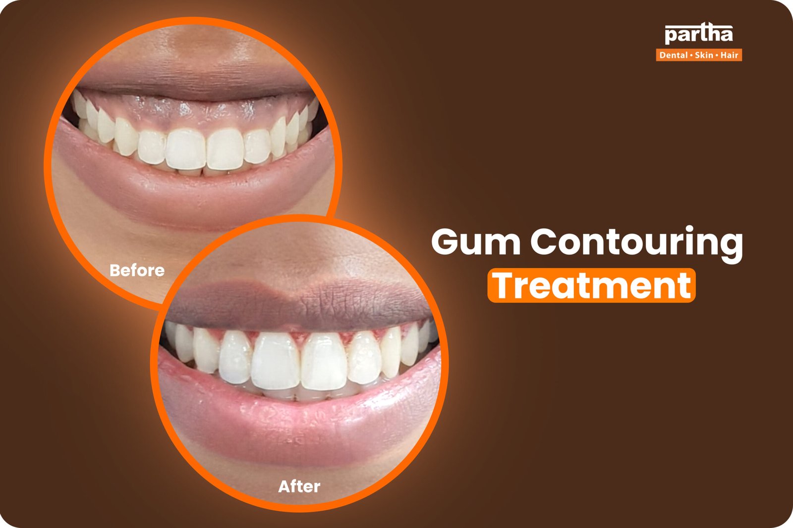 Gum Contouring Treatment Partha Dental