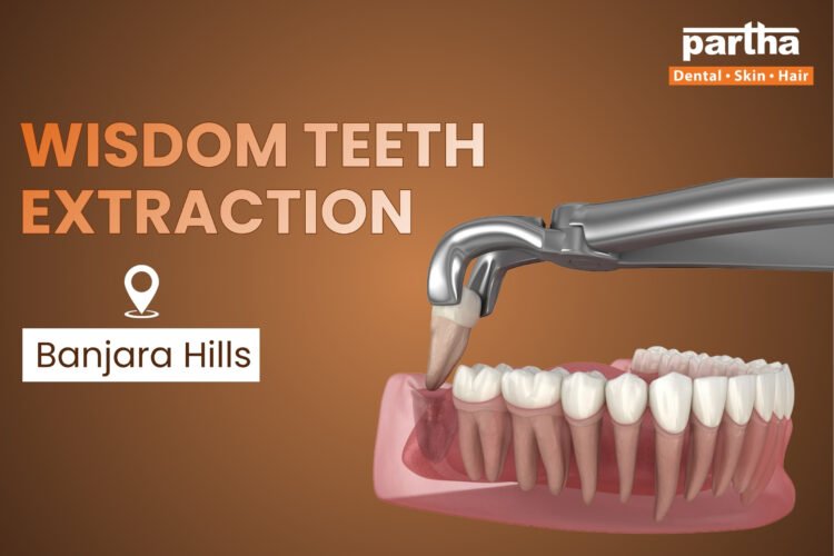 Wisdom-tooth-extraction-Banjara-Hills