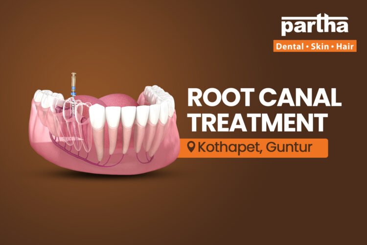 Root Canal treatment in Kothapet, guntur