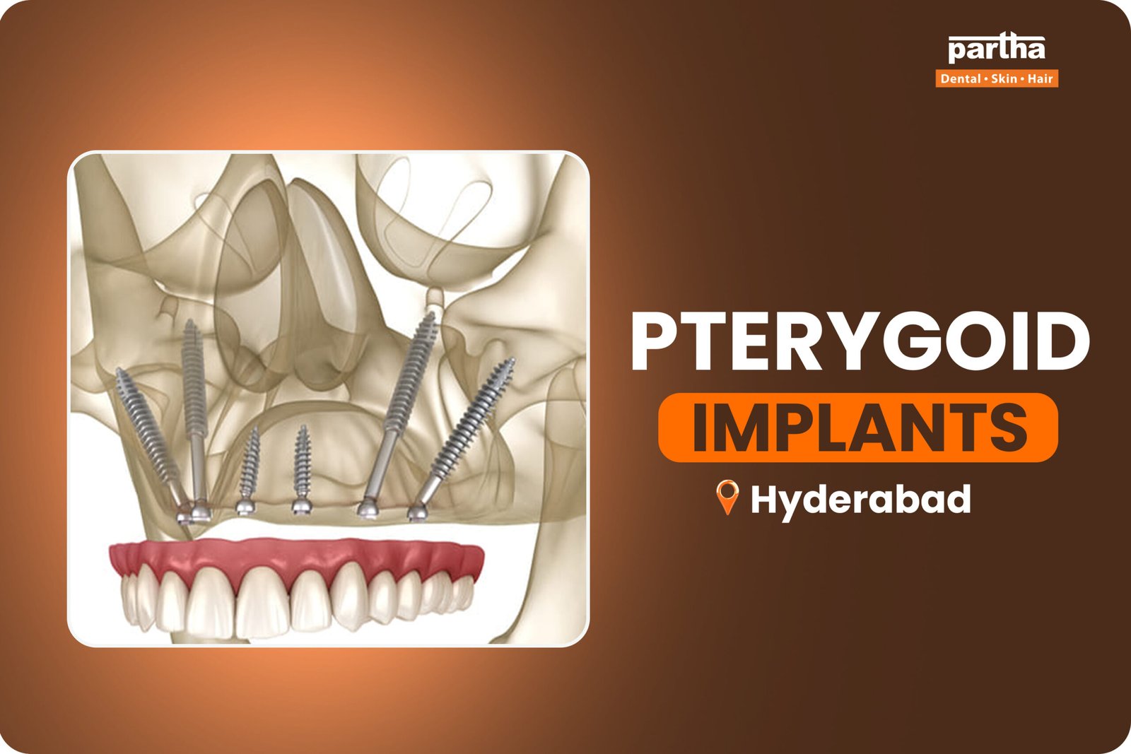 Pterygoid-Implants-in-Hyderabad