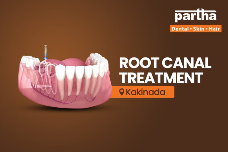 Root Canal Treatment in Kakinada.