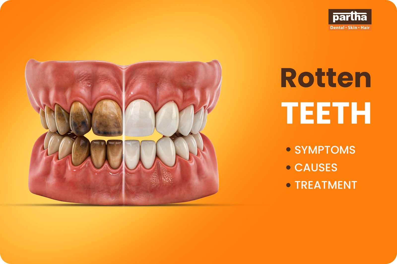 Rotten teeth parthadental
