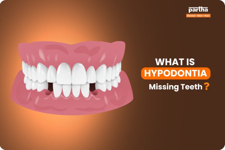 what is hypodontia