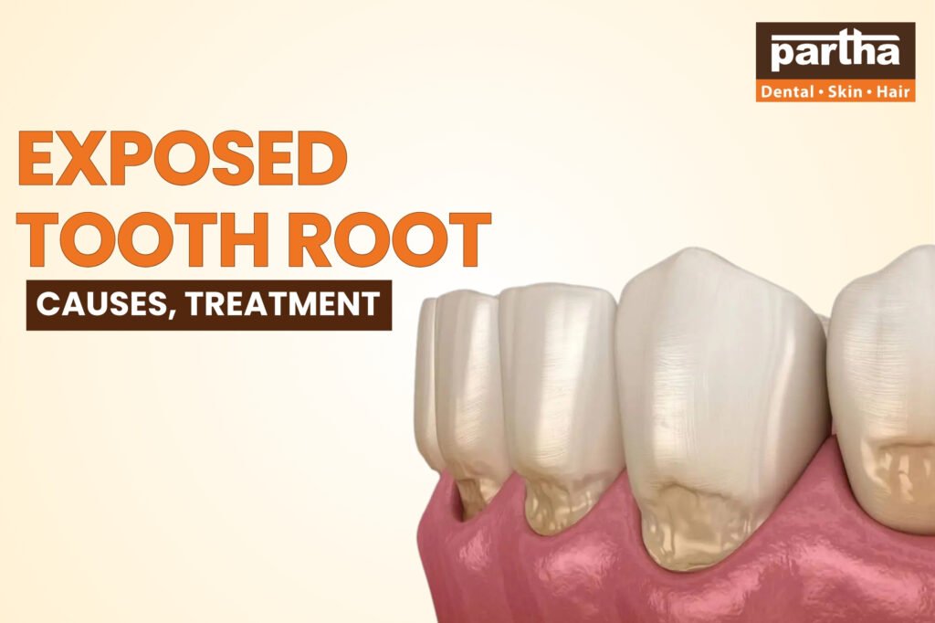 Thoot Roots Exposed Tooth Root: Causes, Symptoms, Treatment & Cost - Partha Dental Hair