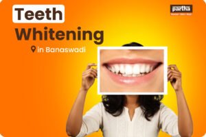 Teeth Whitening Treatment in Banaswadi