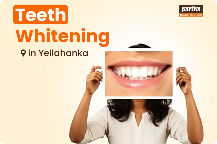 Teeth Whitening in Yelahanka