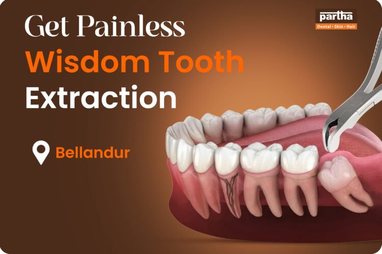 Wisdom teeth Extarction Bellandur