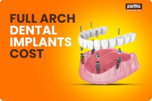 full arch dental implants 1
