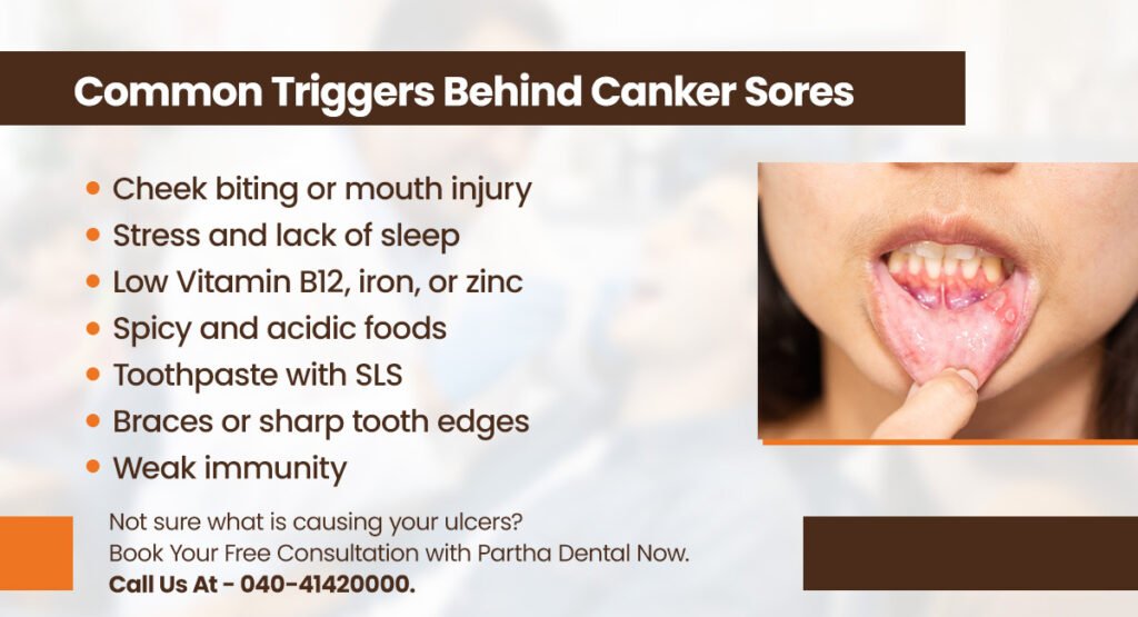 Canker Sores – Symptoms, Causes, Treatment 2 common triggers behind canker sores