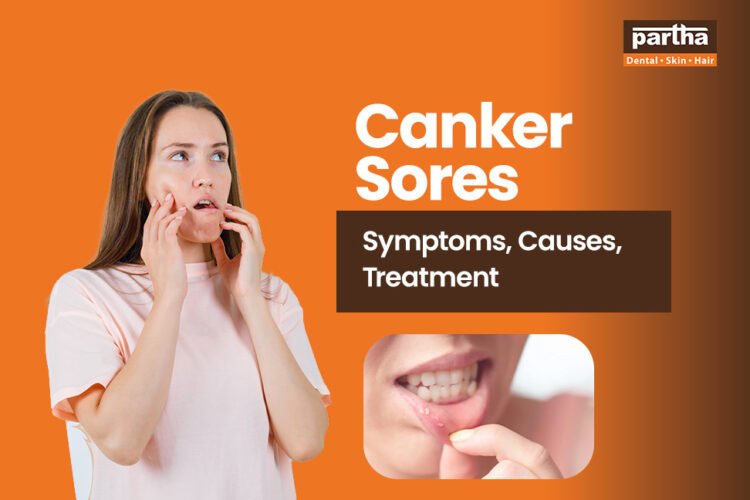 partha canker sores