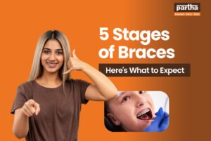 5 stages of braces
