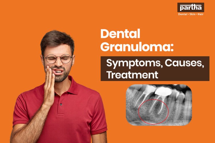 dental granuloma symptoms causes treatment