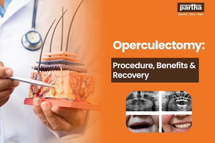 operculectomy procedure benefits recovery