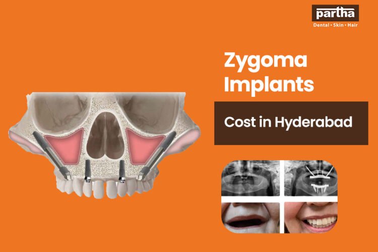zygoma implants cost in hyderabad