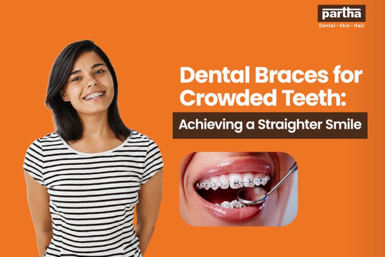dental braces for crowded teeth