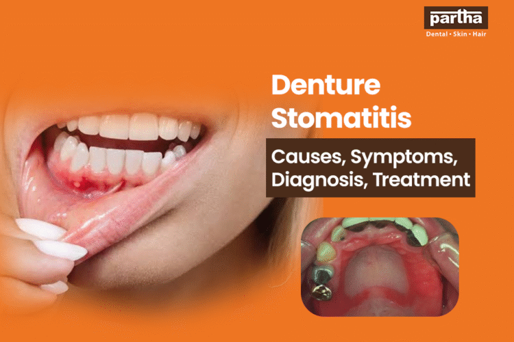 denture stomatitis