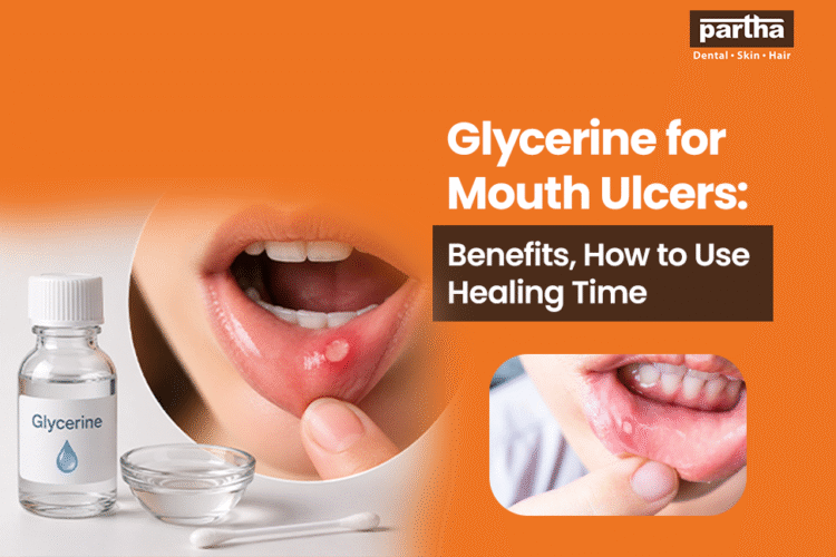 glycerine for mouth ulcers