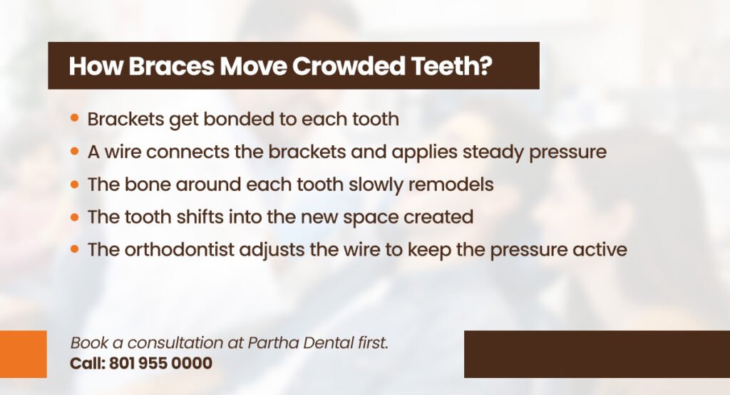Dental Braces for Crowded Teeth: Achieving a Straighter Smile 2 how braces move crowded teeth