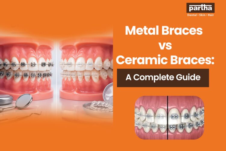 metal braces ceramic braces